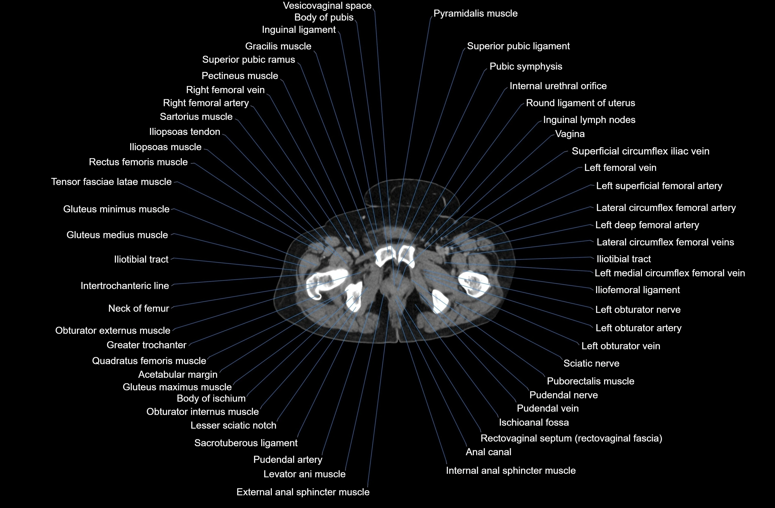 CT Abdomen axial cross sectional anatomy labelled radiology image-00098.webp
